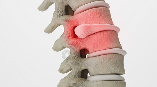 维d腰椎间盘突出场景设计图片