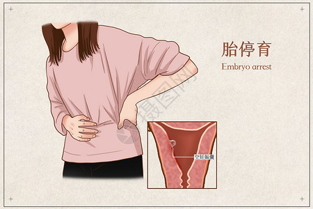胎停育医疗插画高清图片