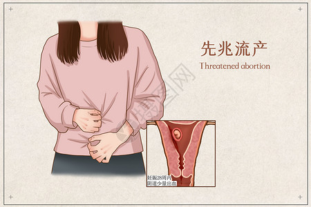 医学产科素材先兆流产医疗插画插画