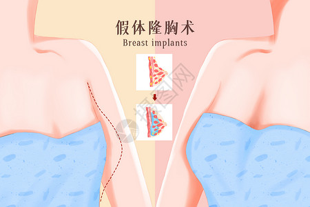 隆胸手术美容整形之假体隆胸插画插画