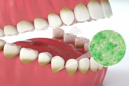 预防龋齿牙周炎场景设计图片