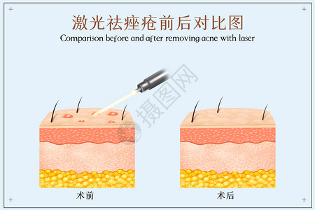 激光祛除痤疮示意图高清图片