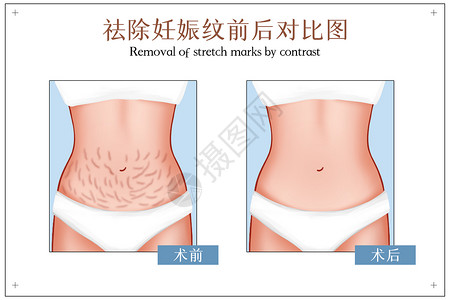 松弛的妊娠纹祛除手术前后对比图插画