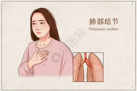肺部结节医疗插画图片