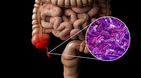 肠道炎症人体阑尾炎场景设计图片