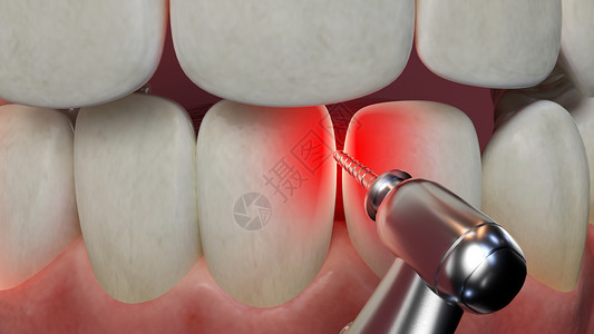口腔红肿C4D牙齿修补场景设计图片