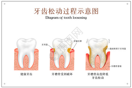 看人体图素材牙齿松动过程牙科配图插画