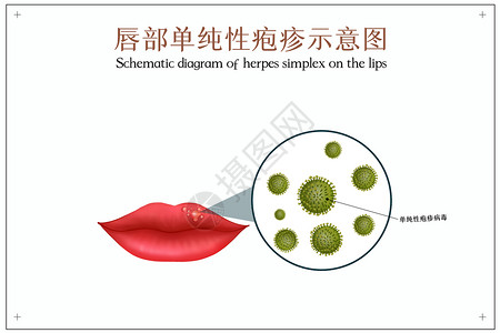 口腔单纯性疱疹口腔医学插图背景图片