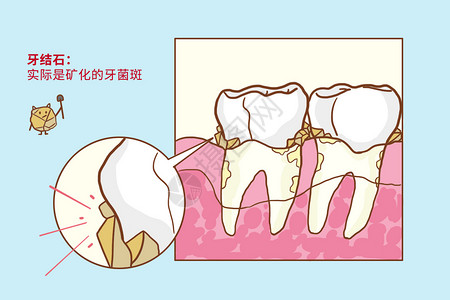 超声波洗牙牙结石口腔医学插画