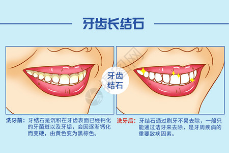 牙科卫生洗牙口腔医学插图插画