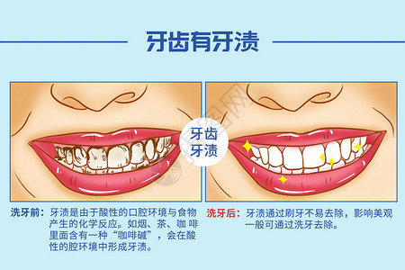 洗牙口腔医学插图高清图片