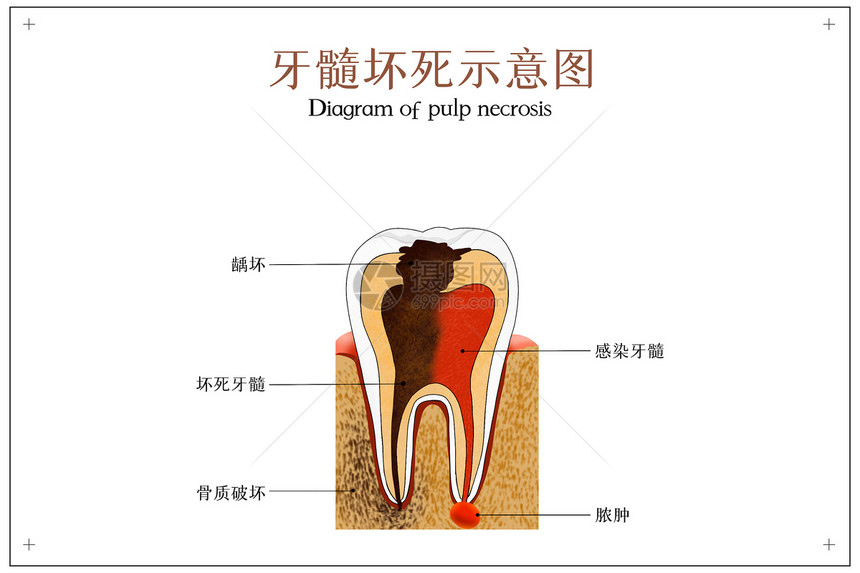 牙髓坏死医疗配图图片