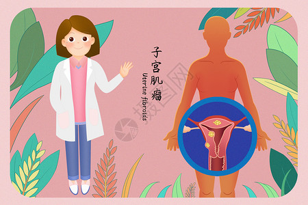 子宫肌瘤医疗插画插画