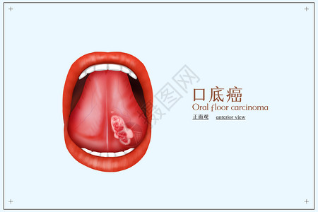 舌頭口底癌医疗配图插画