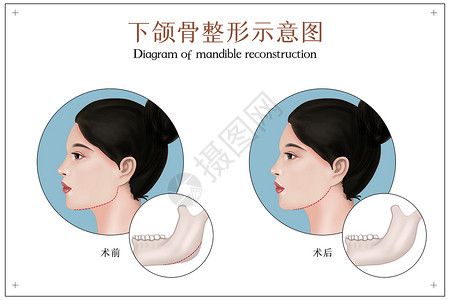 整形手术的下颌骨整形手术示意图插画