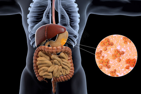 消化系统疾病胃部病变场景设计图片