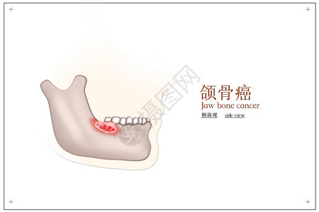 口腔癌颌骨癌医疗健康配图插画