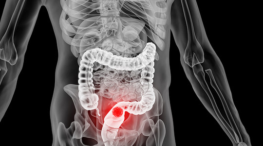 食管恶性肿瘤人体肠癌场景设计图片