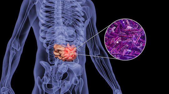人体消化系统人体肠癌场景设计图片