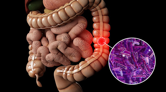 结直肠癌人体肠癌场景设计图片