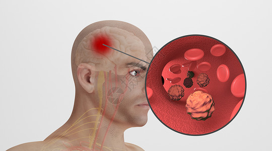 脑供血不足人体脑动脉瘤场景设计图片