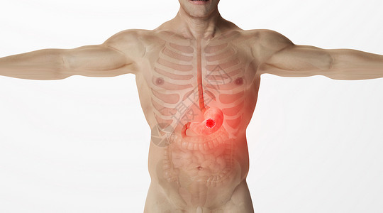 胃肠镜检查人体胃癌场景设计图片