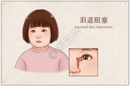 眼科学泪道阻塞医疗插画插画