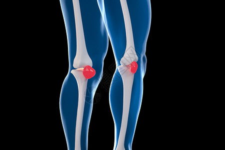 角质层受损膝关节半月板损伤设计图片