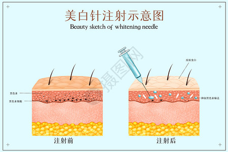 黑色素美白针注射示医美配图插画