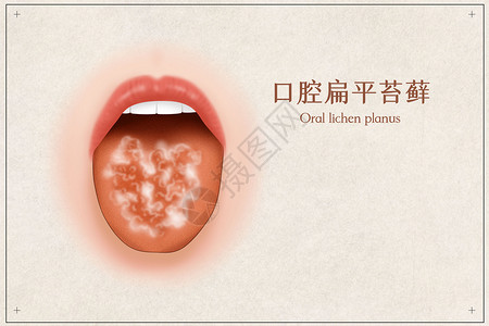舌侧口腔扁平苔藓医疗插画插画