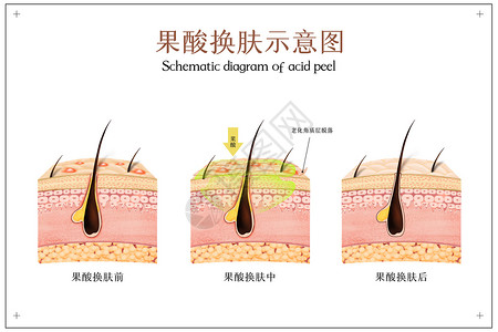 代謝果酸换肤医美配图插画