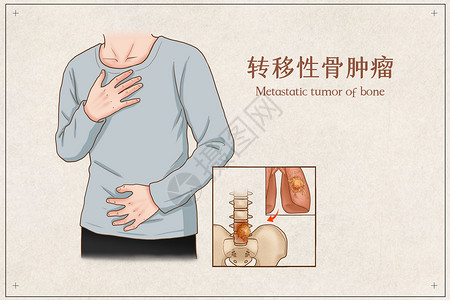 转移性骨肿瘤医疗插画高清图片