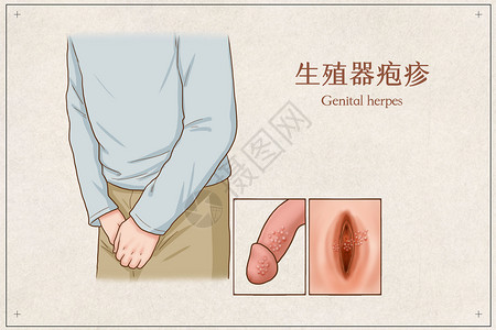 生殖器疱疹医疗插画背景图片