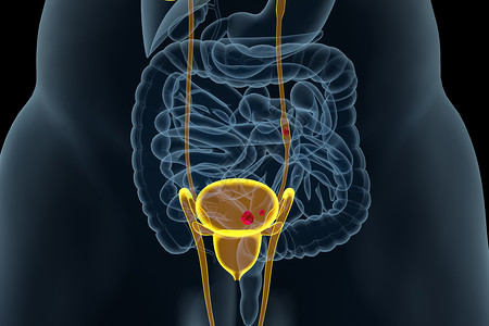 尿频尿急尿路结石设计图片