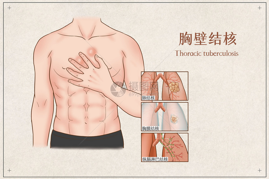 胸壁结核医疗插画图片