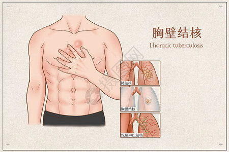 胸壁结核医疗插画高清图片