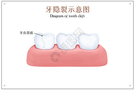 牙龈敏感牙隐裂示意图插画