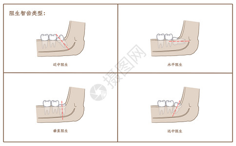 阻生智齿类型高清图片