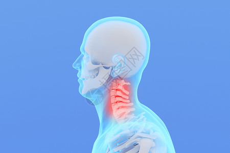 椎间盘突出C4D颈椎疾病设计图片