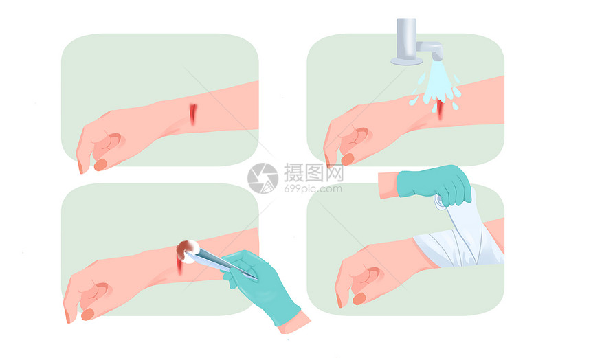 医疗手部受伤处理包扎伤口过程图片