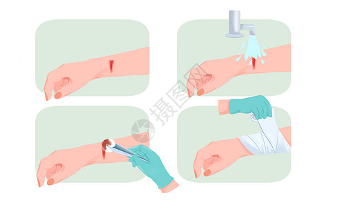 图片处理医疗手部受伤处理包扎伤口过程插画