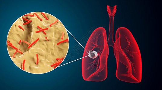 肺部疾病场景高清图片