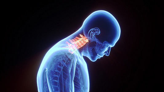 脊柱畸形3D颈椎病场景设计图片