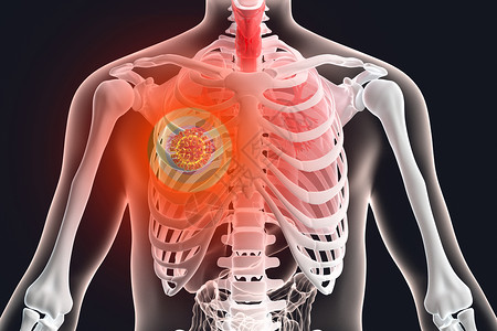 新冠感染3D人体肺癌场景设计图片