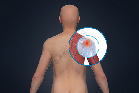 3D肩周炎场景高清图片