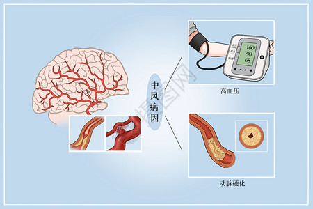 风瘫中风病因医疗插画插画