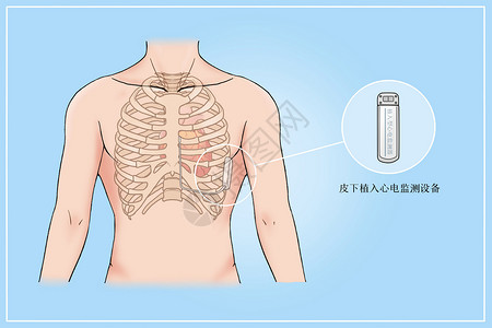 皮下植入心电监测设备治疗心脏病医疗插画高清图片