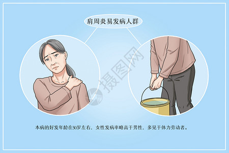 肩周炎易发病人群医疗插画图片