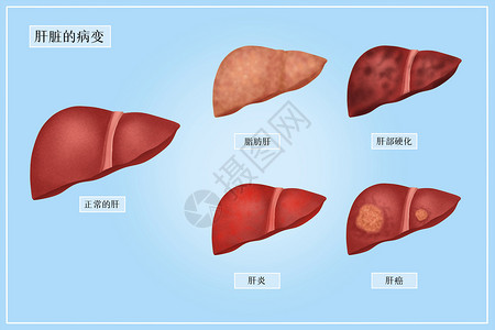 肝脏的病变医疗插画高清图片