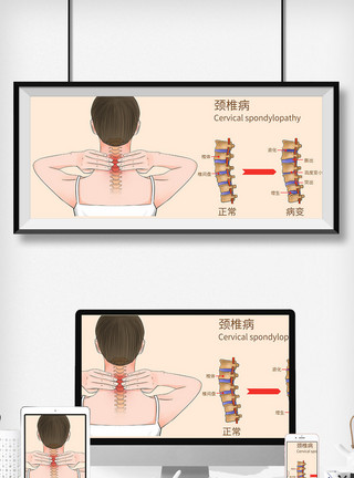 按摩颈椎颈椎病科普医疗插画模板